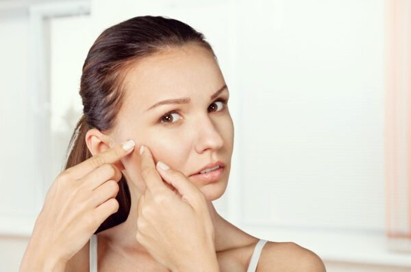 A acne merece atenção especial no outono e inverno