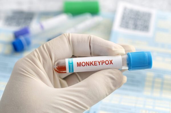 O TERCEIRO CASO DE MONKEYPOX FOI CONFIRMADO EM CAMPINAS