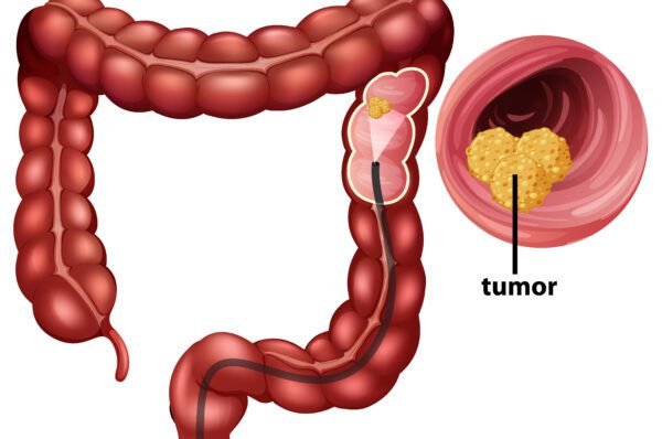 Cresce o diagnóstico de câncer no intestino no Brasil